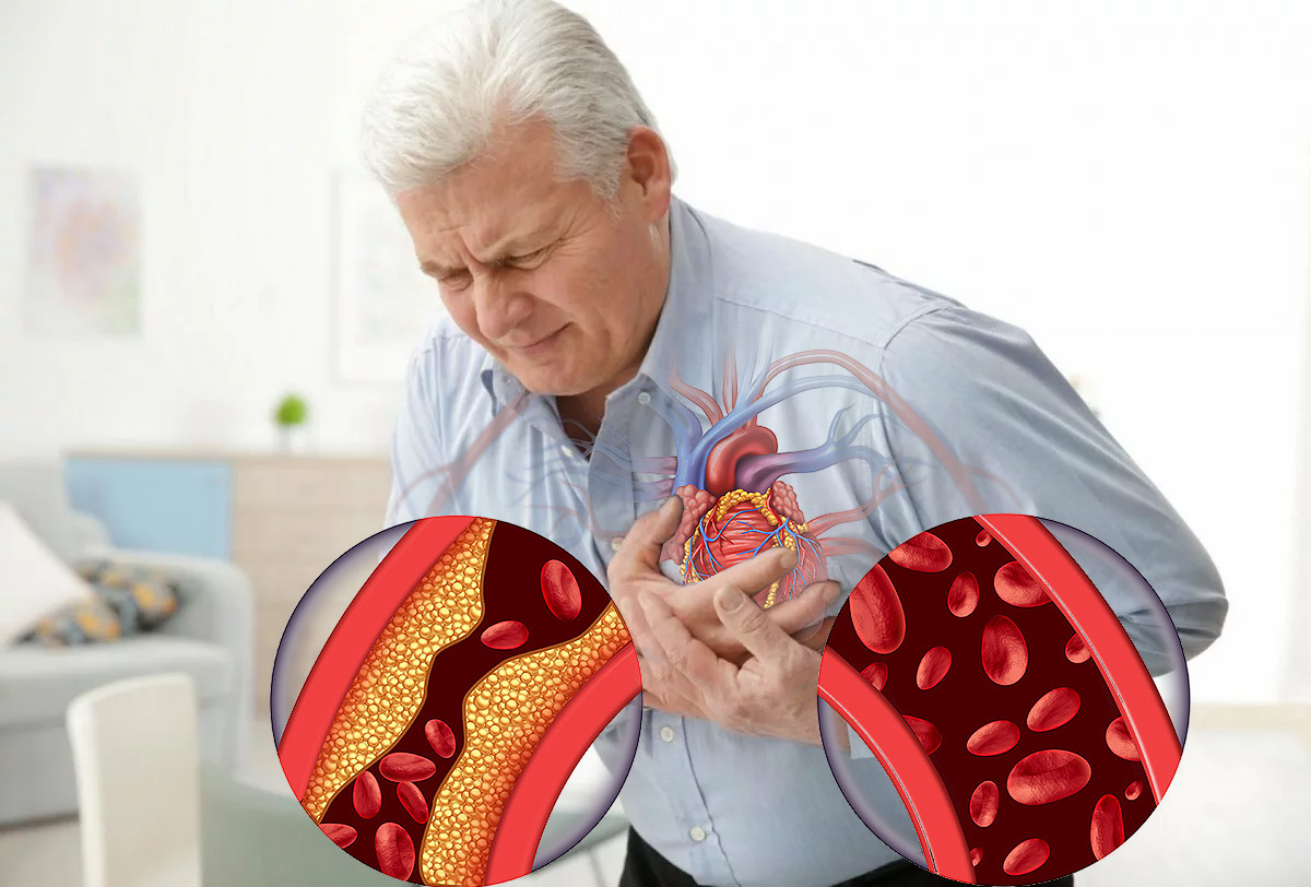Различными заболеваниями а также. Ишемическая болезнь сердца (ИБС). ИБС стенокардия атеросклероз симптомы. Юрак ишемик касалликлари. Сердечнососулистые заболевания.